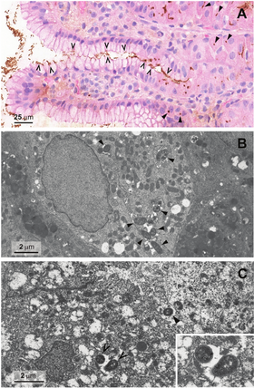 Demonstration of Helicobacter pylori in the corpus mucosa by immunohistochemical stain (A) and transmission electron microscopy (B, C)